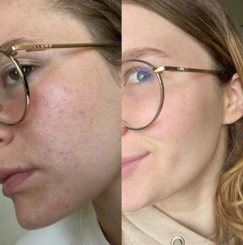 MySkinPro™