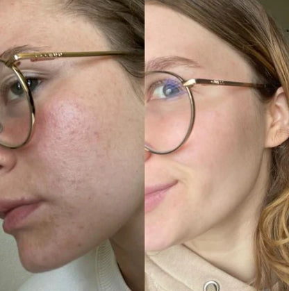 MySkinPro™